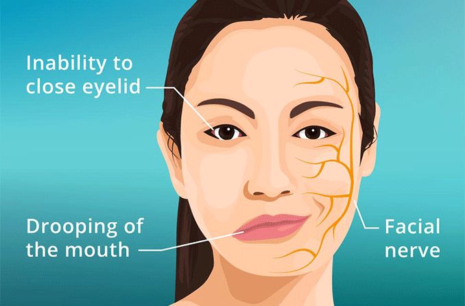 Illustration of a woman suffering from Bell's Palsy symptoms