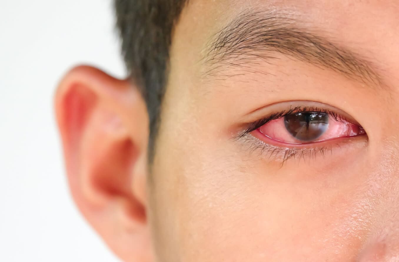 Red eyes are a symptom of Cogan's Syndrome