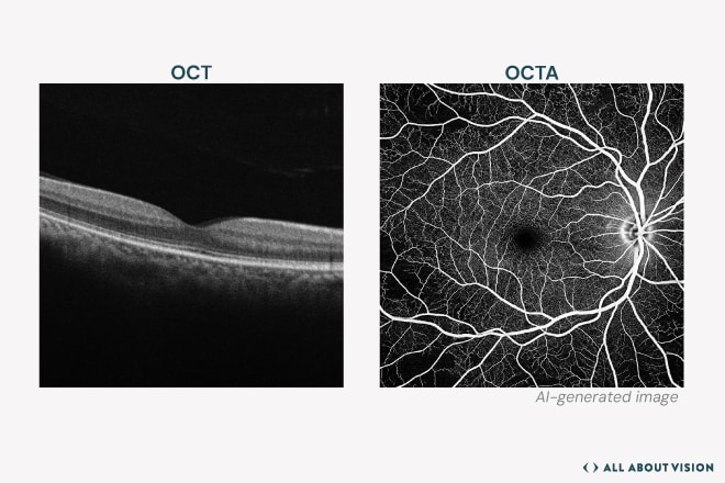 Oct vs Octa Imaging