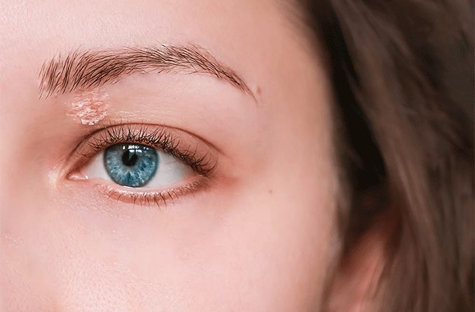 girl with psoriasis on upper eyelid