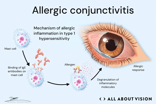 Allergic conjunctivitis and its triggers Woman outdoors rubbing an irritated eye as airborne pollen triggers symptoms of allergic conjunctivitis.