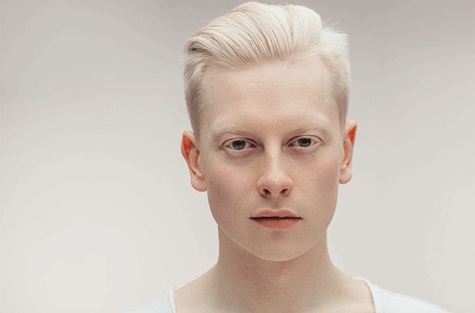 man with albinism