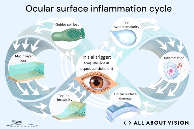 The cycle behind worsening dry eye disease Infographic showing the ocular surface inflammation cycle and factors that contribute to worsening dry eye disease.