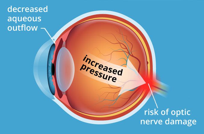 illustration of an eyeball with increased pressure (ocular hypertension)