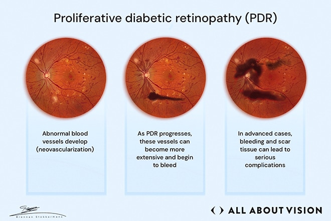 Final stage of diabetic retinopathy progression Retinal images showing proliferative diabetic retinopathy with abnormal blood vessel growth, bleeding, and scarring.