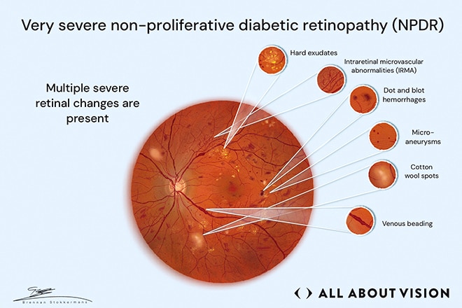 Advanced stage of diabetic retinopathy before progression Retinal image showing very severe nonproliferative diabetic retinopathy with extensive retinal damage and bleeding.