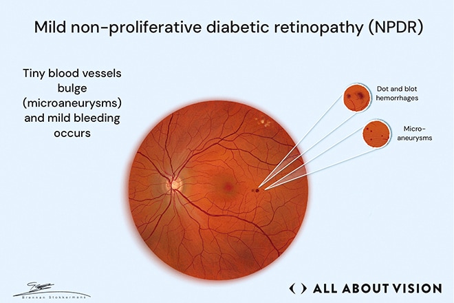 First stage of diabetic retinopathy explained Retinal illustration showing mild nonproliferative diabetic retinopathy with microaneurysms and small hemorrhages.