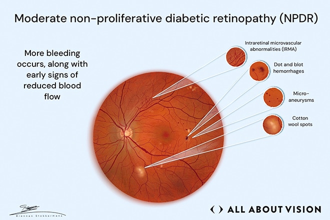 Second stage of diabetic retinopathy changes Retinal image showing moderate nonproliferative diabetic retinopathy with bleeding and reduced blood flow signs.