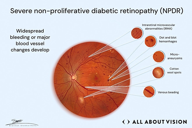 Third stage of diabetic retinopathy progression Retinal image showing severe nonproliferative diabetic retinopathy with widespread bleeding and vessel damage.