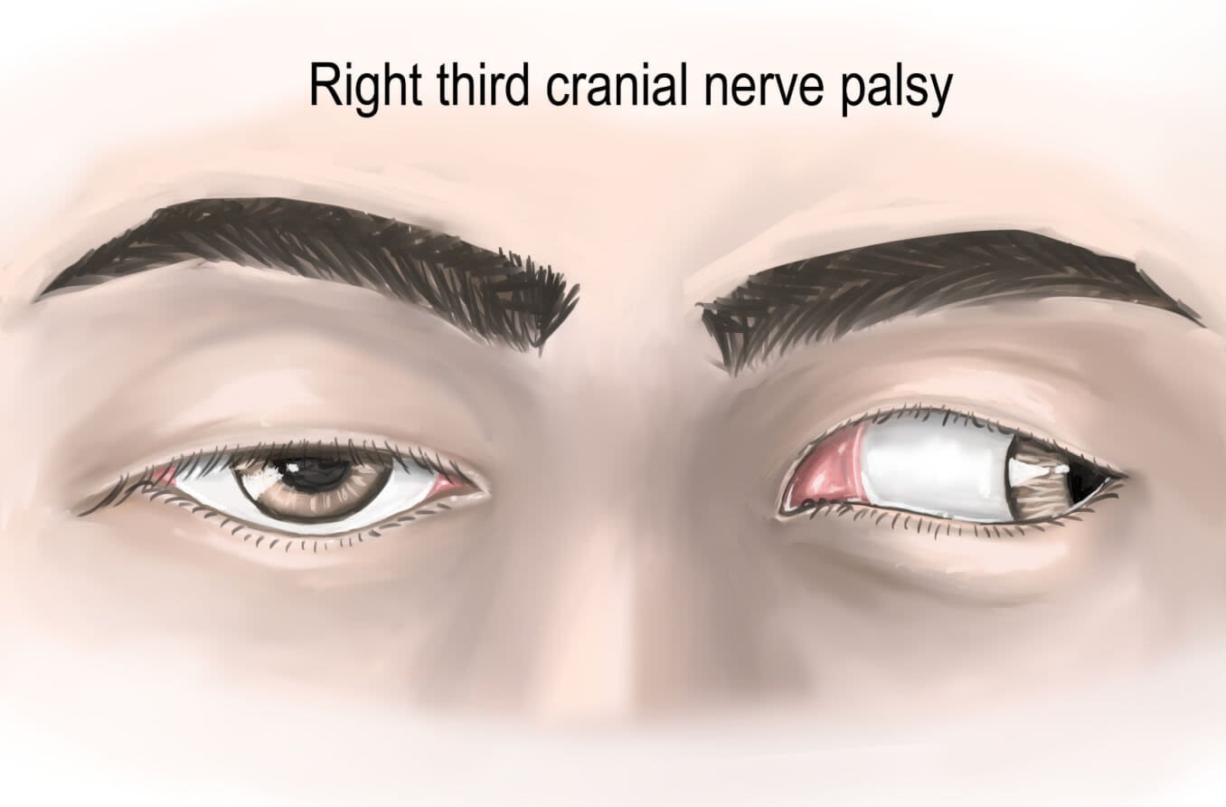 The clinical presentation of right third cranial nerve lesion