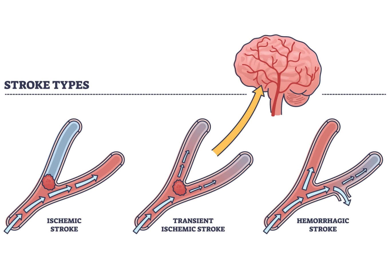 Labeled educational scheme with brain blood supply problem and ischemic, transient or hemorrhagic examples vector illustration.