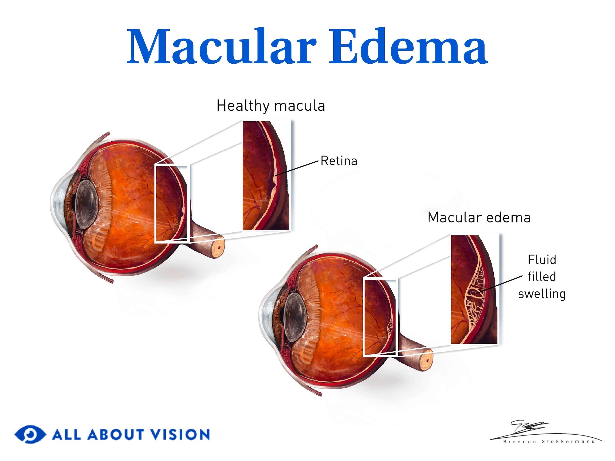 Healthy macula v macular edema.