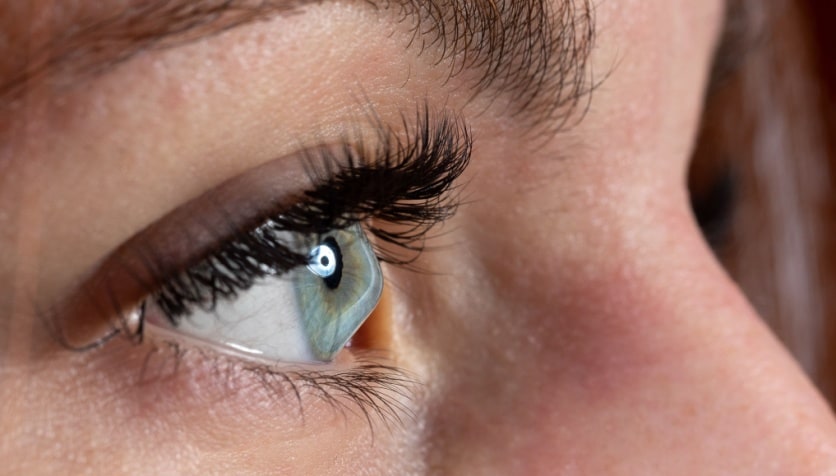 Close-up image of a woman's eye with keratoconus.