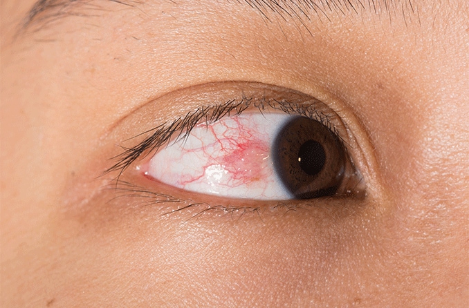 What is episcleritis?