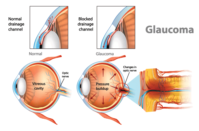 Illustration showing open-angle glaucoma. Intraocular pressure in the back of the eye.