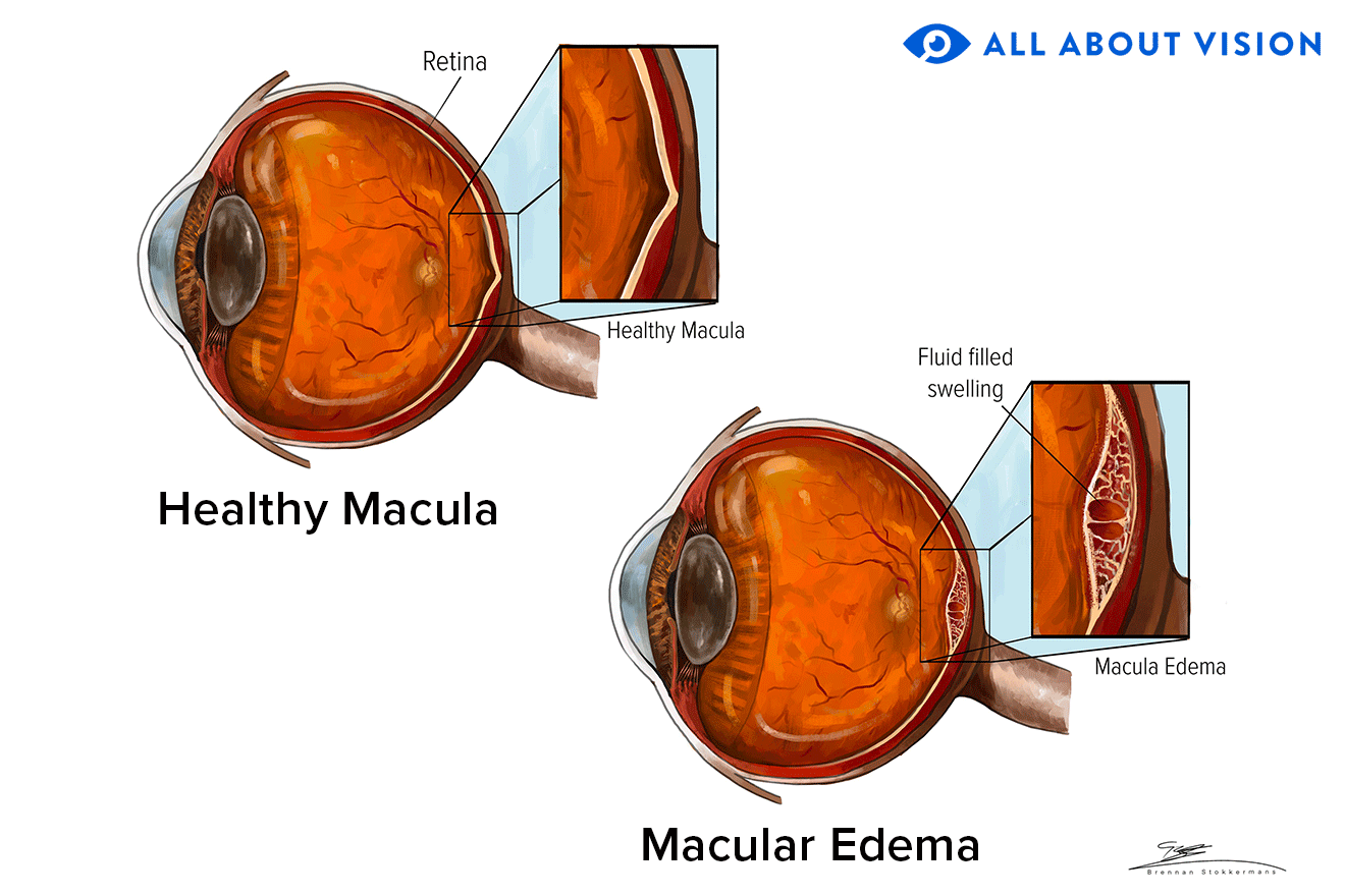 Macular edema: Symptoms, causes, diagnosis and treatment