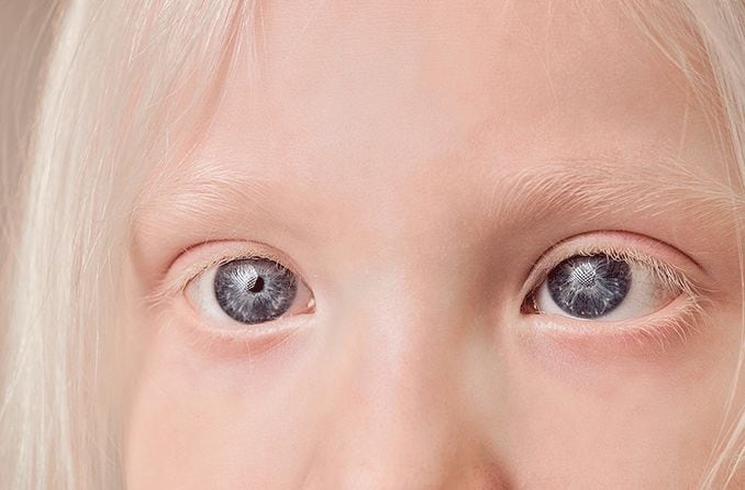 Ocular albinism: How it’s diagnosed and treated