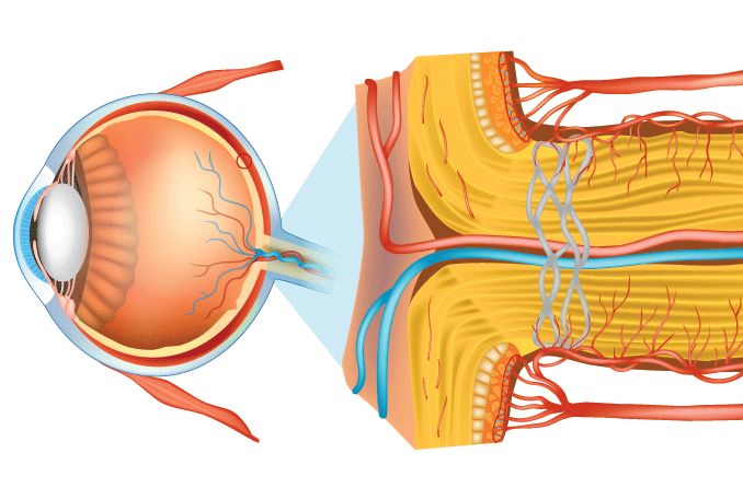 Optic nerve drusen: Symptoms, causes and treatment