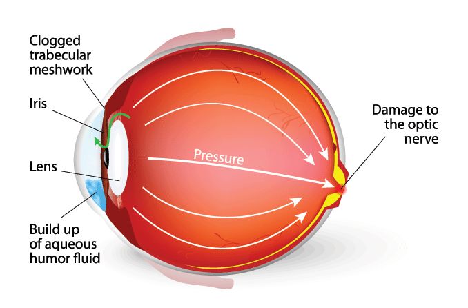 Pseudoexfoliation syndrome and pseudoexfoliation glaucoma: Causes, symptoms and treatment