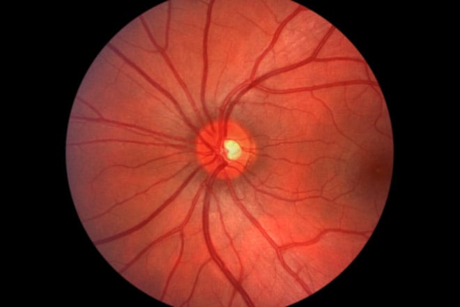 CMV Retinitis, Cytomegalovirus Symptoms