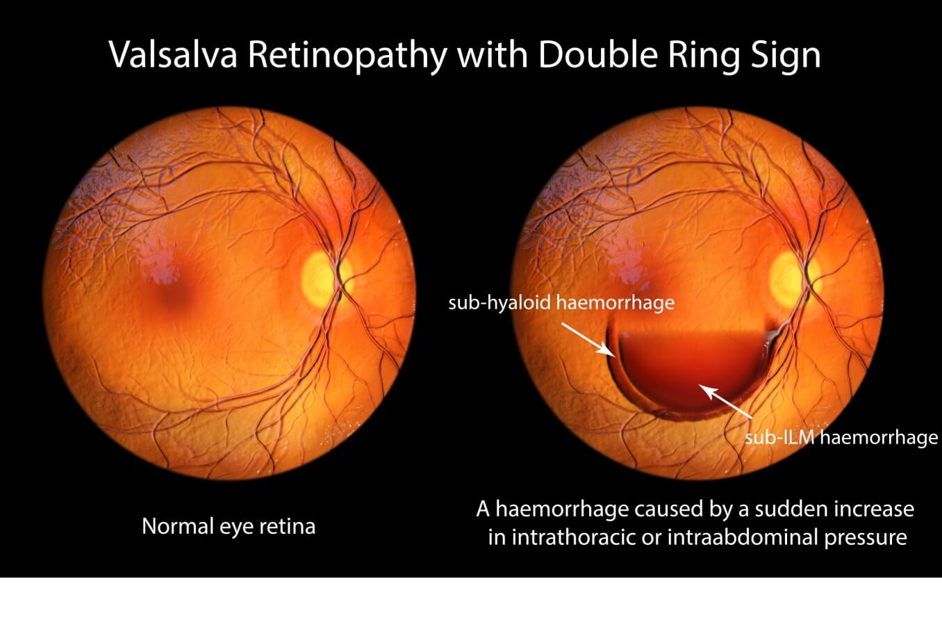 Close up of man with broken blood vessel in eye