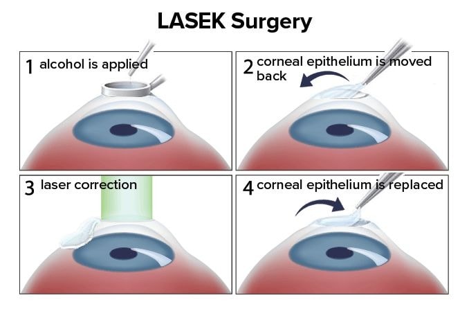 LASEK eye surgery: How it works