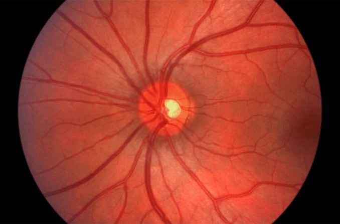 Image of the back of a healthy eye