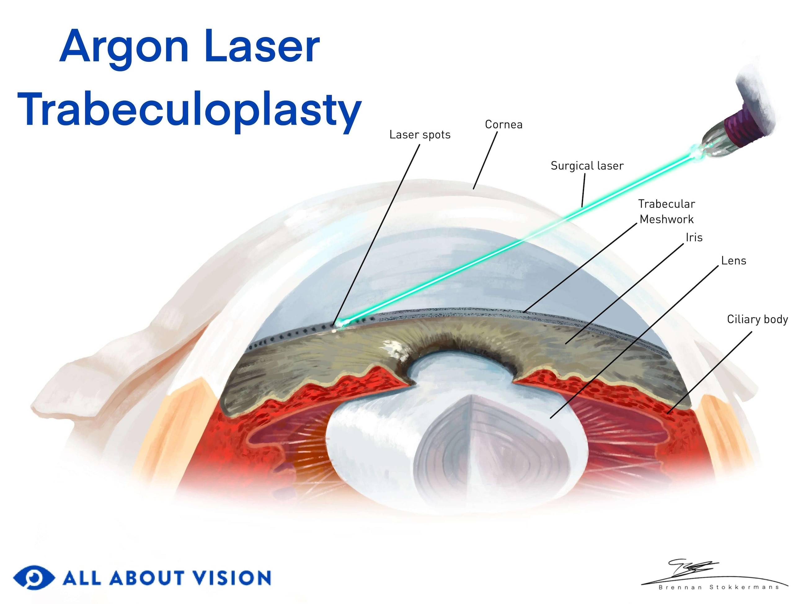 Argon laser trabeculoplasty (ALT)