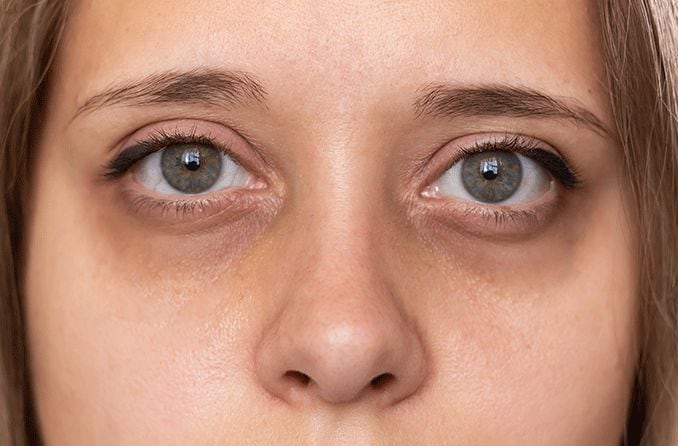 Dark circles under the eyes: Causes and how to get rid of them