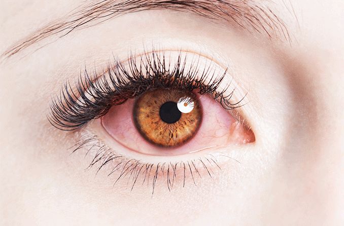 How do you treat an eye infection from makeup?