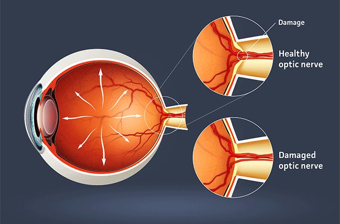 Optic nerve: Anatomy, function and conditions Optic nerve: Anatomy, function and conditions