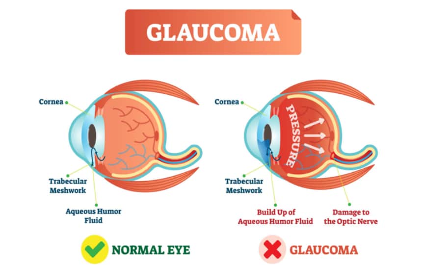 Trabecular Meshwork depiction in a healthy eye v an eye with glaucoma.