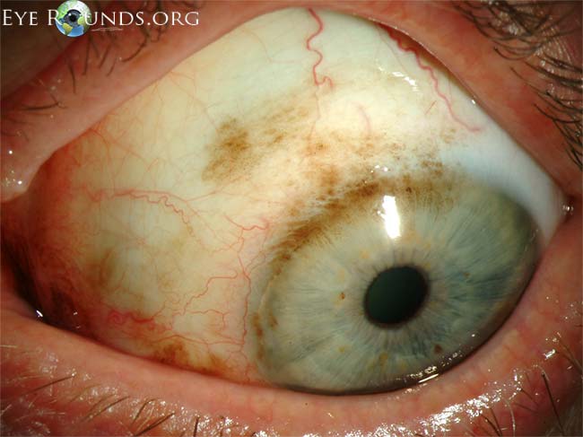Ocular Melanosis