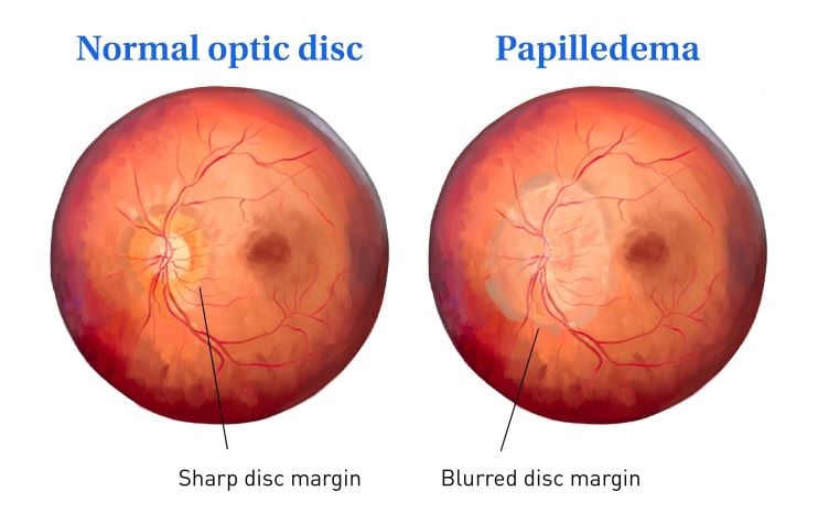 Diagram of Papilledema