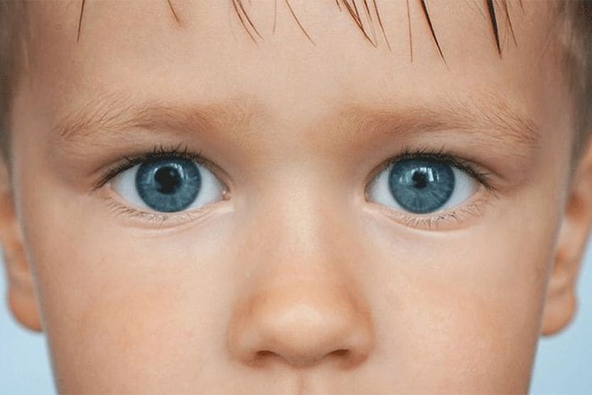 young boy with anisocoria