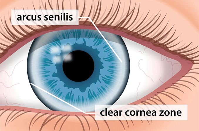 Arcus senilis (corneal arcus)