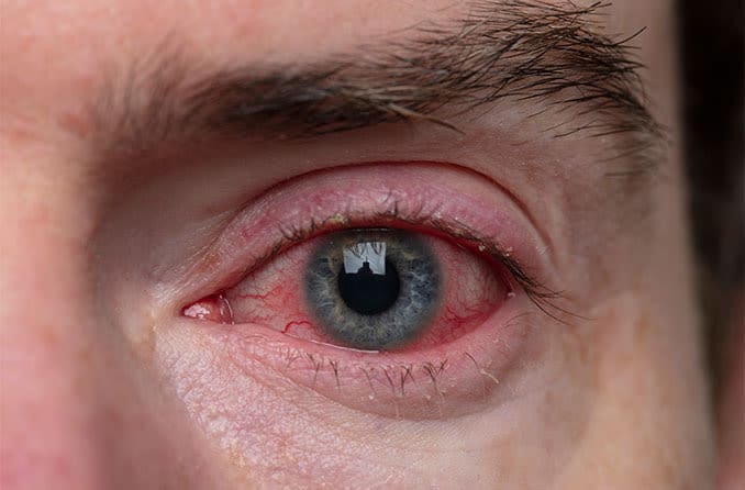 What is blepharitis?