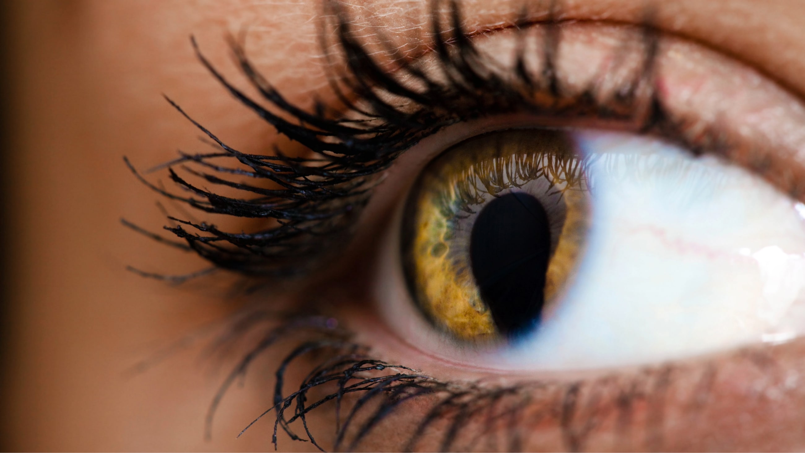 Cat eye syndrome: Causes, symptoms and treatment Cat eye syndrome: Causes, symptoms and treatment