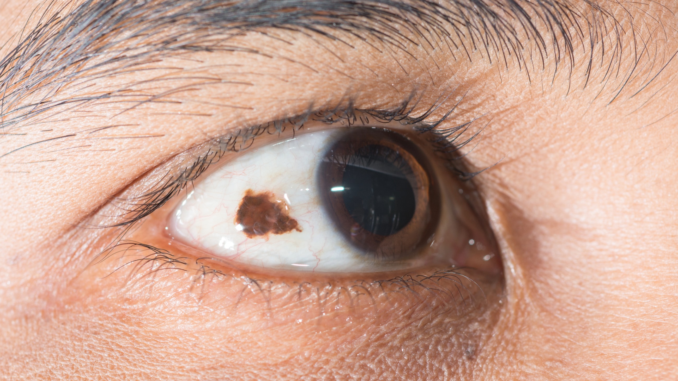 A closer look at the eye freckles on the whites of your eye A closer look at the eye freckles on the whites of your eye