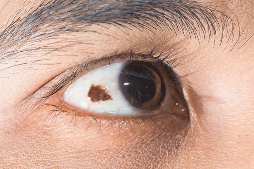 closeup of an eye with a conjunctival nevus