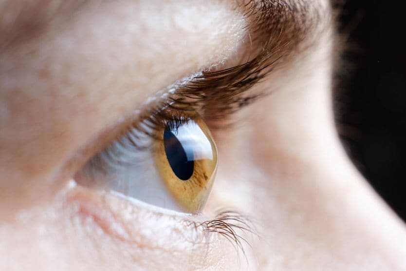 Macro photo of the human eye with Corneal Ectasia.