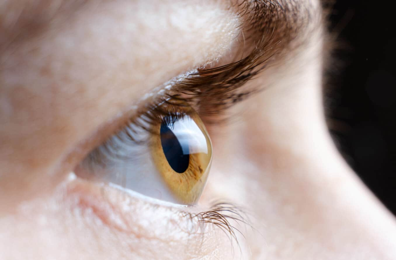 Corneal ectasia: Causes, symptoms and treatment