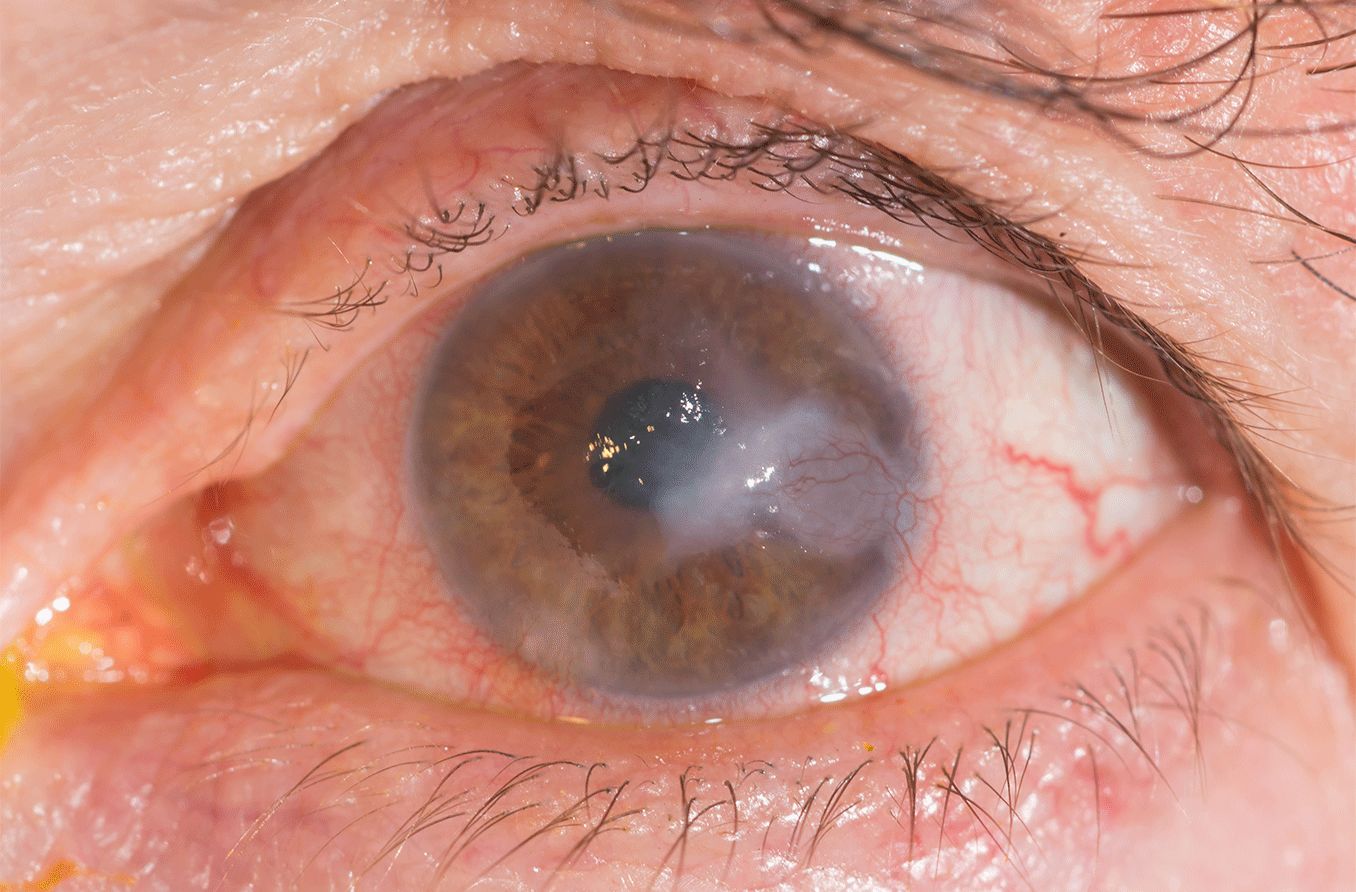 Corneal infiltrates: Causes, treatment and more