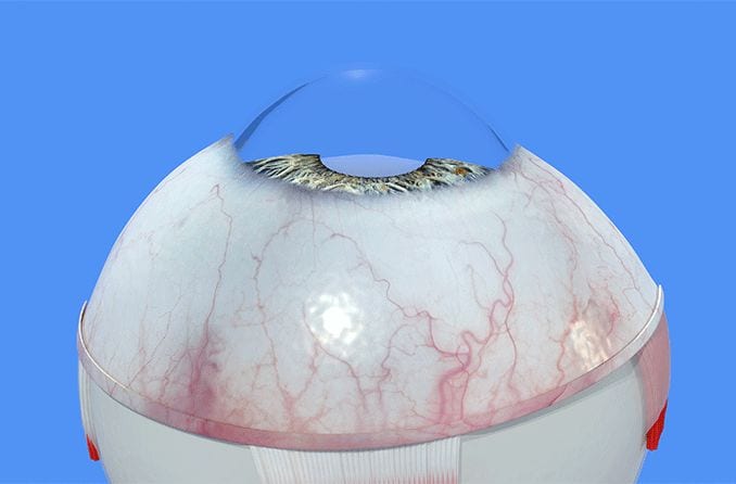 A guide to causes and treatment of corneal neovascularization