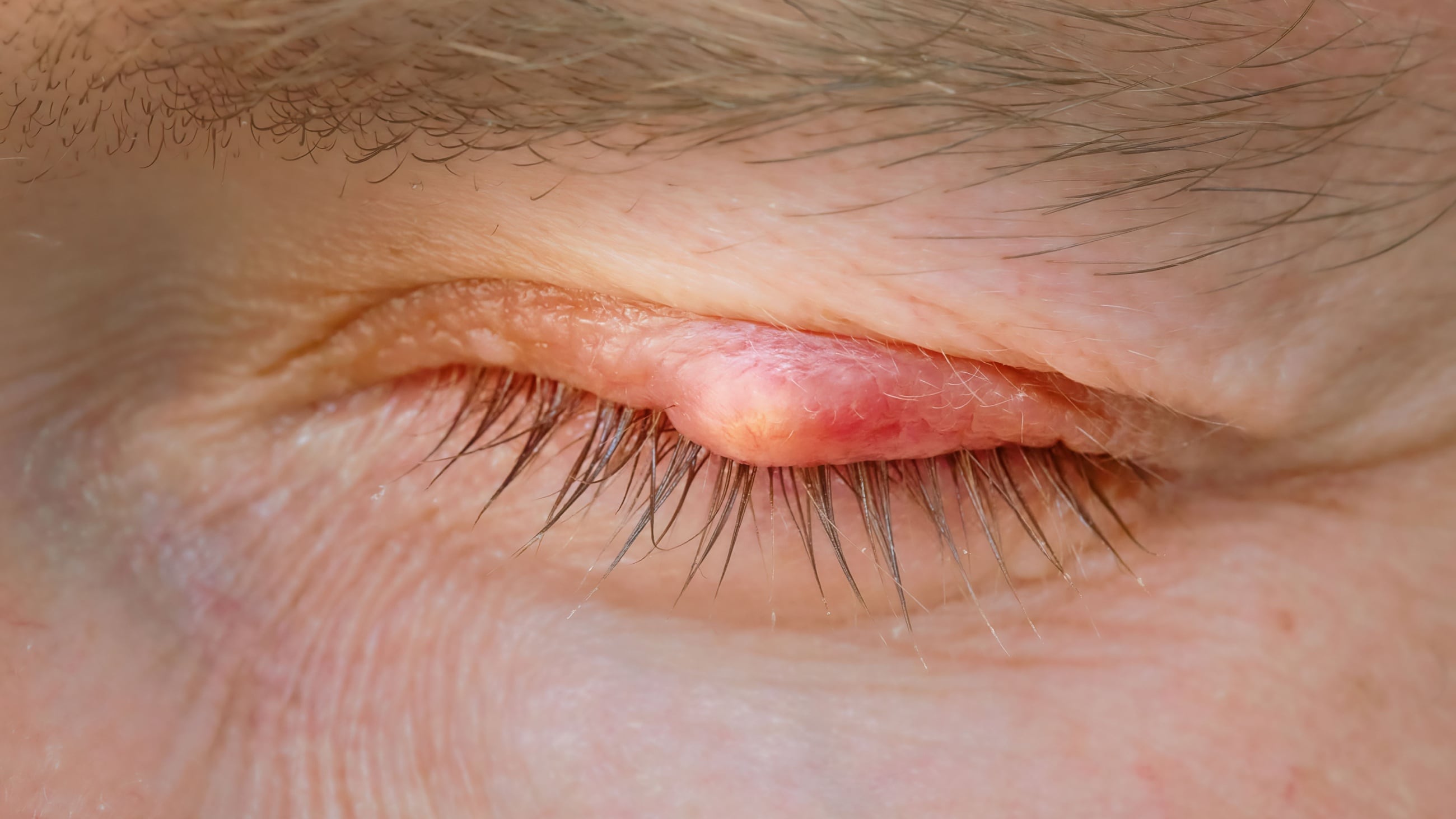 man with an eyelid cyst man with an eyelid cyst