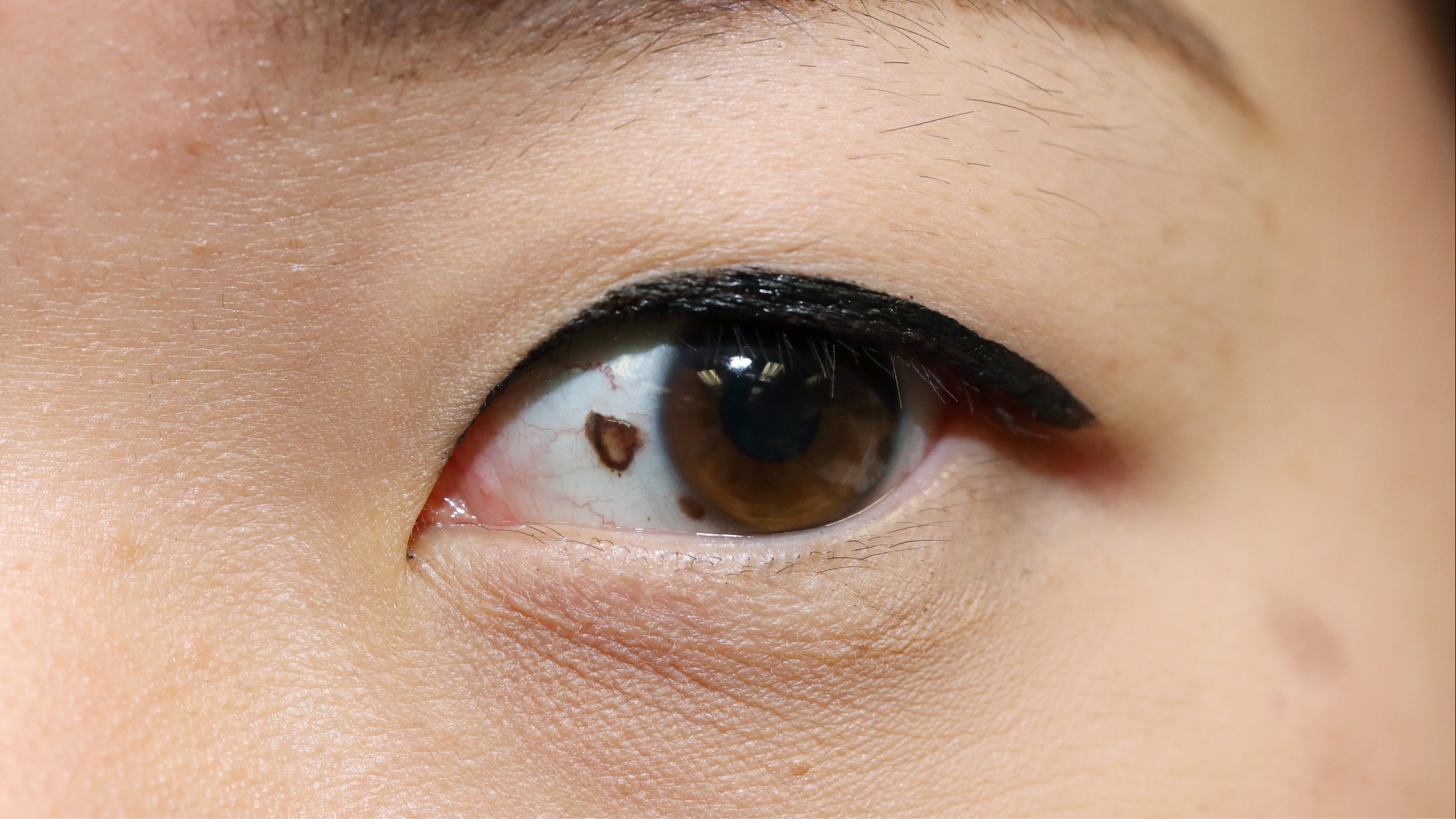 What does an eye freckle mean? What does an eye freckle mean?