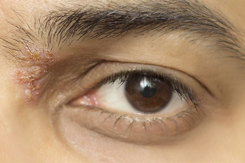 Closeup of a man with eye shingles