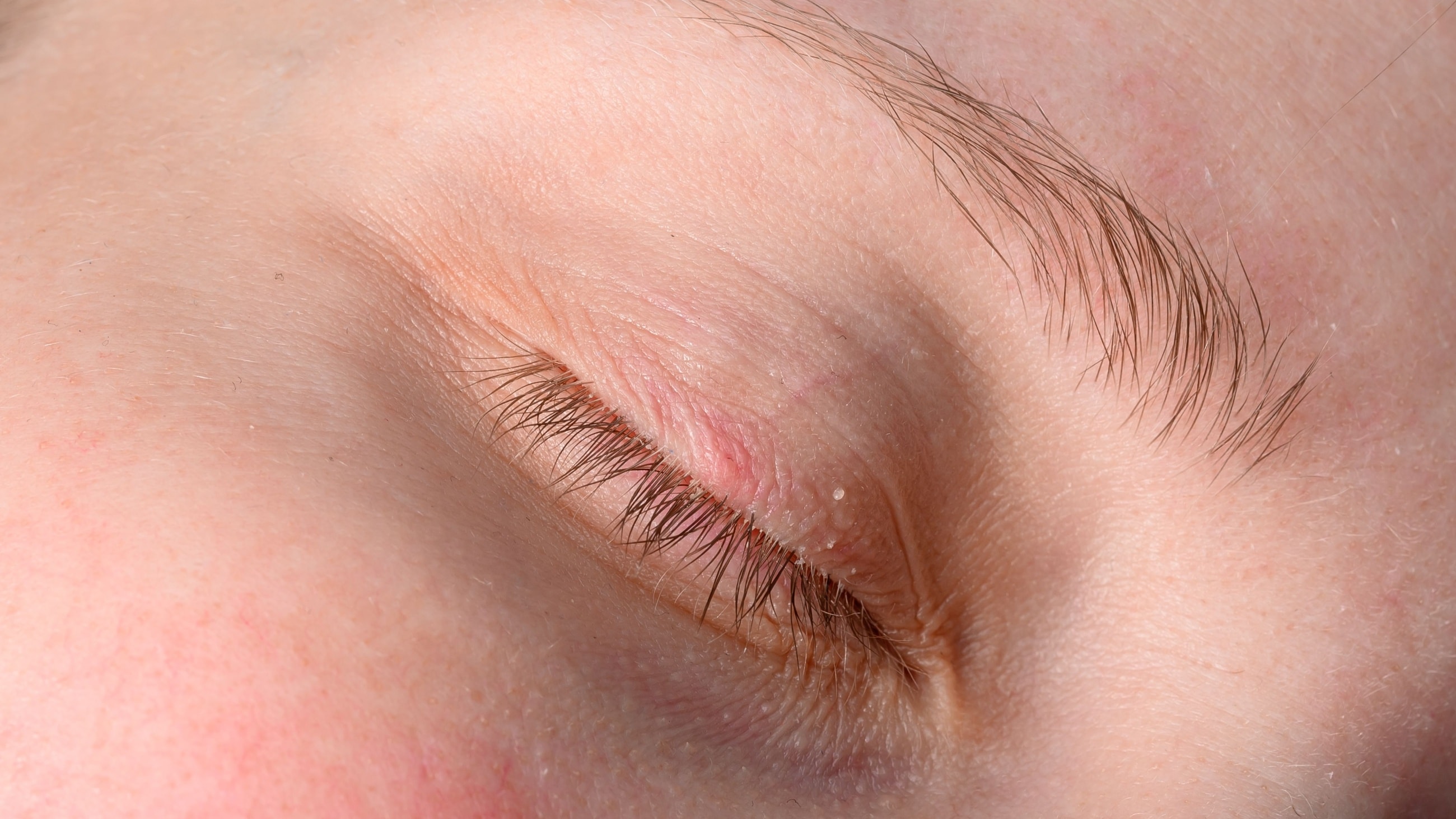 image of eyelash with lice image of eyelash with lice