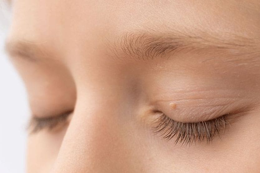 closeup of an eyelid skin tag
