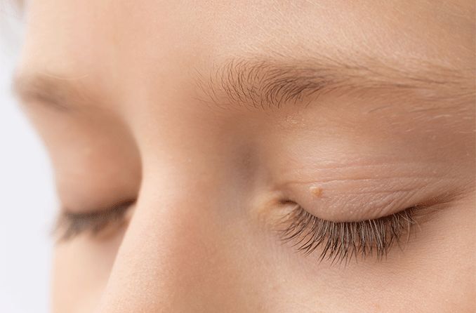 How do I remove a skin tag on my eyelid?